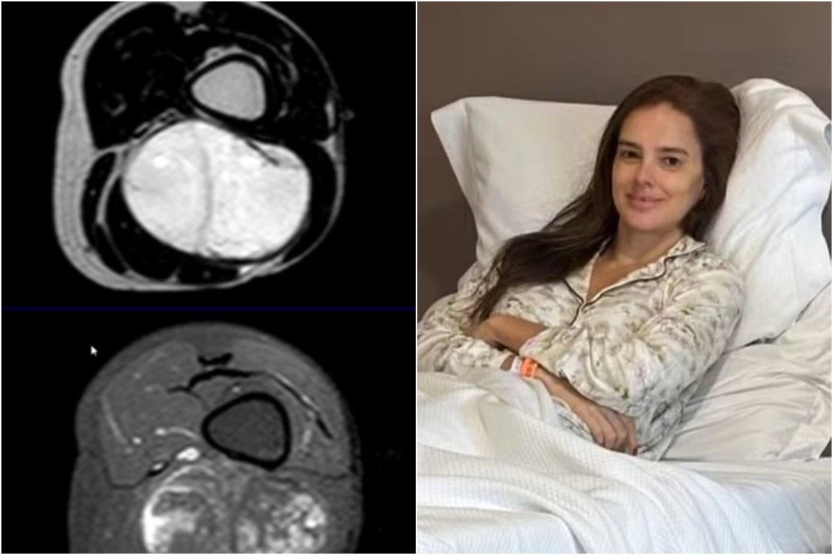 Médicos se surpreendem com situação de Vera Viel após cirurgia para retirada de tumor e ela fala