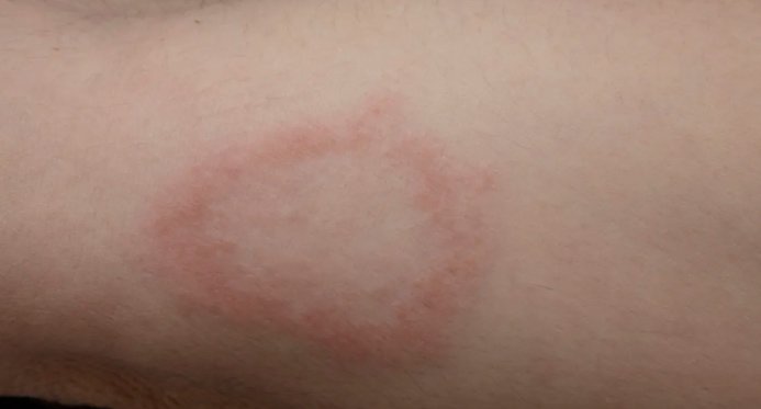 Hanseníase: veja sintomas e diagnóstico da doença que tem vacina em estudo