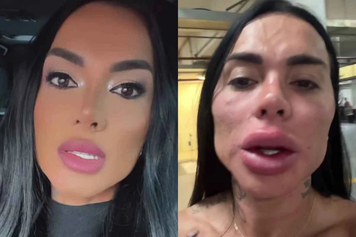 ExFazenda Kamila Simioni faz harmonização facial para deixar o rosto mais natural e mostra o resultado