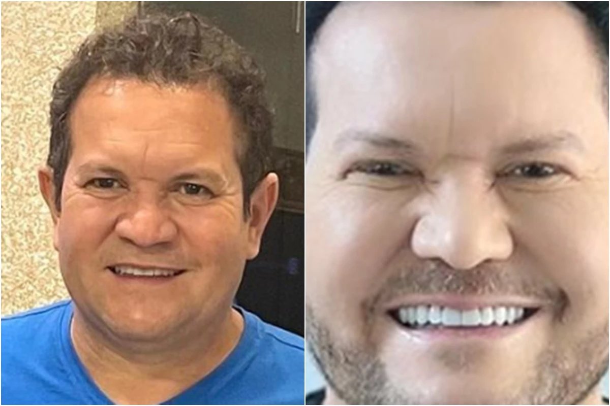 Ximbinha passa por procedimento no rosto para ficar mais bonita, mas resultado vira piada: ‘que coisa horrível’