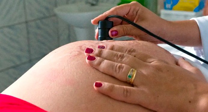 Health recomenda cálcio para todas as mulheres grávidas para evitar eclâmpsia