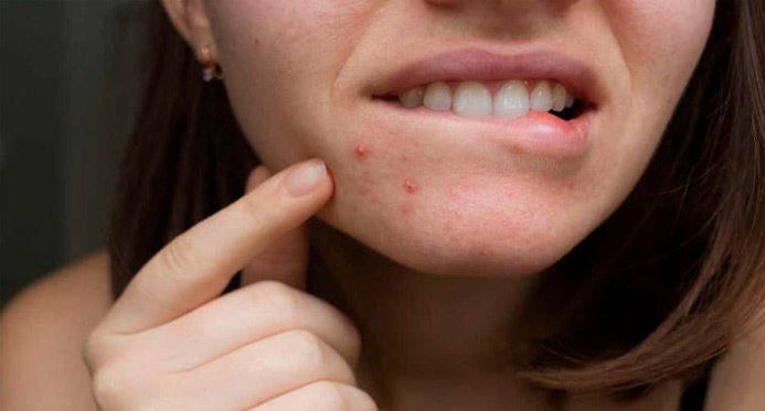Alimentos que causam acne; Saiba o que são e o que fazer para evitar