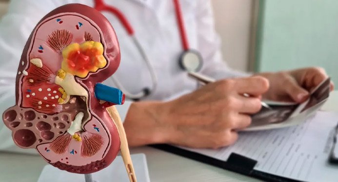 O câncer renal deve crescer quase 80% no Brasil e na América Latina até 2050