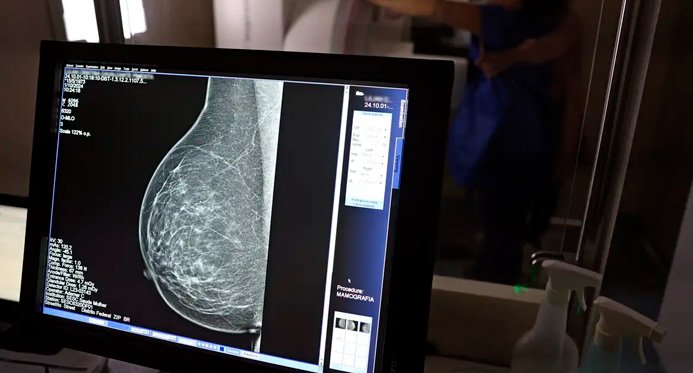 Ministério da Saúde começa a recomendar mamografia a partir dos 40 anos de idade