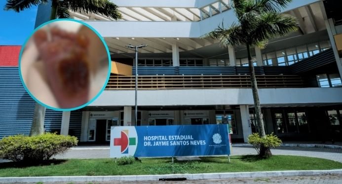 A técnica de enfermagem que queimou o pé de bebê no ES é disparada após a auditoria
