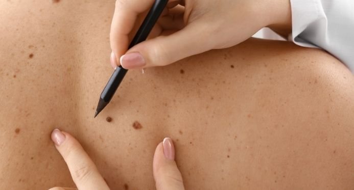 Câncer de pele já causou quase 100 mortes no ES até 2025; saiba identificar os sinais