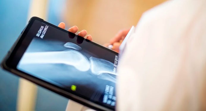 Espera-se que os casos de osteoporose disparem até 2050, inclusive no Brasil