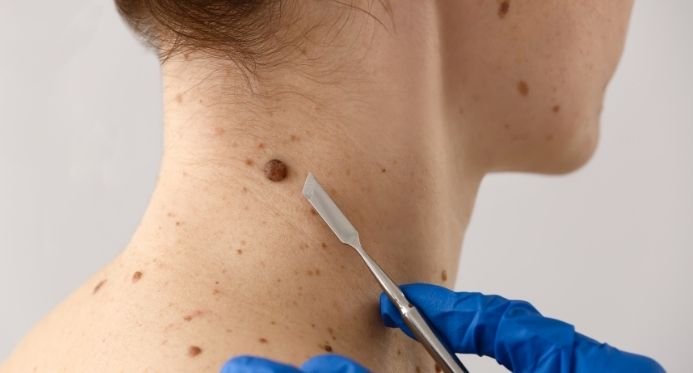 Linhares recebe mutirão com consultas gratuitas contra câncer de pele neste sábado