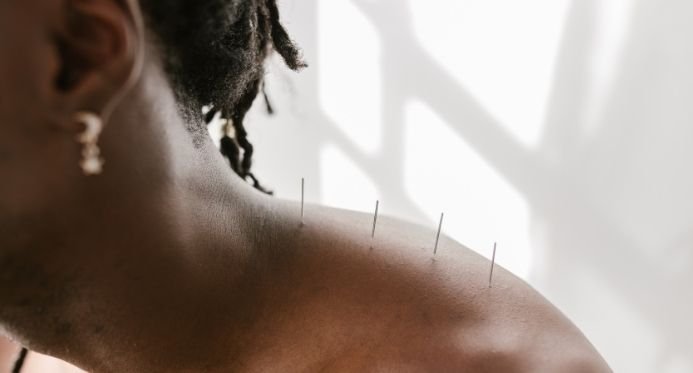 Acupuntura passa a ser profissão regulamentada no Brasil; descubra quem pode atuar