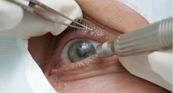 Lula opera catarata no olho esquerdo e recebe alta; entenda como é a cirurgia