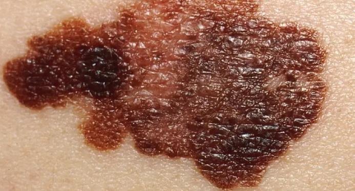 5 sinais e sintomas de câncer de pele (melanoma e não melanoma)