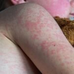 Casos de sarampo aumentam 32 vezes nas Américas e Brasil reforça alerta para viajantes