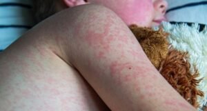 Casos de sarampo aumentam 32 vezes nas Américas e Brasil reforça alerta para viajantes