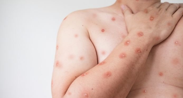 ES confirma primeiro caso de Mpox em 2026 e Ministério da Saúde entra em alerta