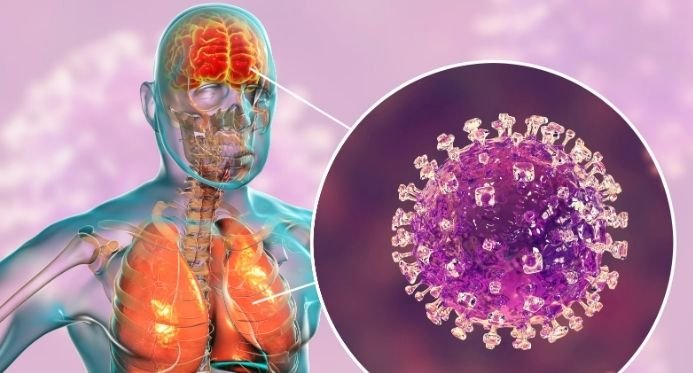 Ministério da Saúde nega casos do vírus Nipah no Brasil e descarta risco de pandemia