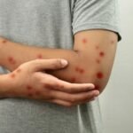 ES confirma terceiro caso de Mpox em 2026 e Estado acrescenta 50 notificações