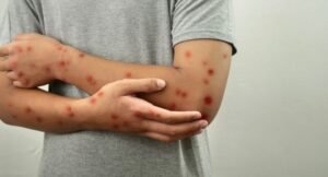 ES confirma terceiro caso de Mpox em 2026 e Estado acrescenta 50 notificações