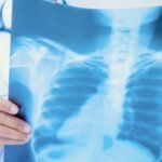 ES registra 1.916 casos de tuberculose em 2025 e reforça importância do tratamento gratuito pelo SUS