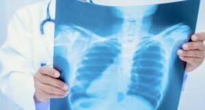 ES registra 1.916 casos de tuberculose em 2025 e reforça importância do tratamento gratuito pelo SUS