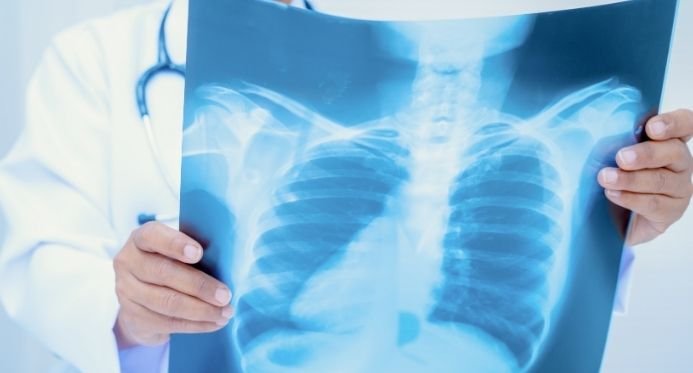 ES registra 1.916 casos de tuberculose em 2025 e reforça importância do tratamento gratuito pelo SUS