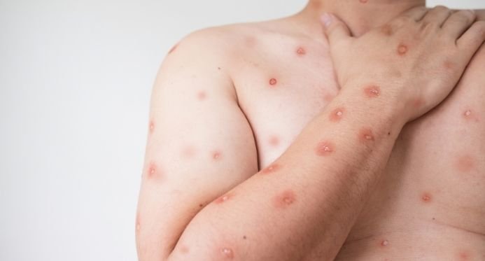 Espírito Santo confirma segundo caso de Mpox em 2026 e já tem 44 notificações