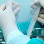 Saúde incorpora transplante de membrana amniótica para tratar diabetes