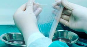 Saúde incorpora transplante de membrana amniótica para tratar diabetes