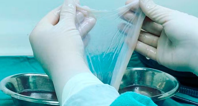 Saúde incorpora transplante de membrana amniótica para tratar diabetes